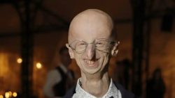 ‘progeria’:-entenda-sindrome-que-causa-envelhecimento-precoce-e-matou-sammy-basso-aos-28-anos